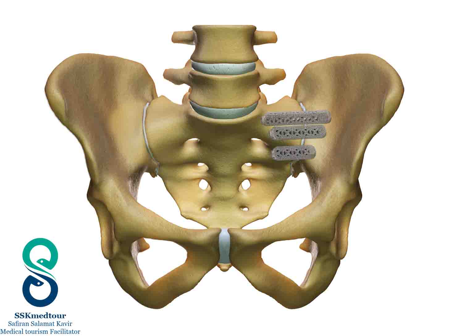 Joint Fusion Surgery All You Need To Know joint-fusion-surgery-all-you-need-to-know
